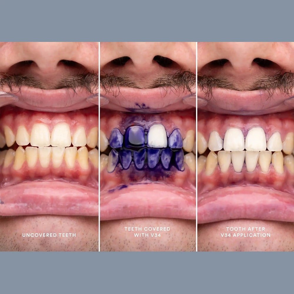 کرم سفیدکننده دندان v34
